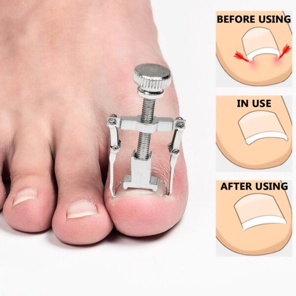 2 Pieces Ingrown Toenail Lifter Ingrown Toenail Tool Toe Clamp Stainless Steel Foot Care Tool for Paronychia (Gold) - Image 2